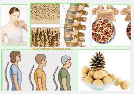 Khi bị loãng xương bạn nên ăn gì?