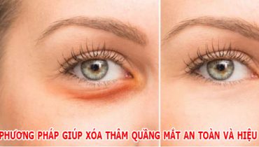 10 phương pháp giúp xóa thâm quầng mắt an toàn và hiệu quả