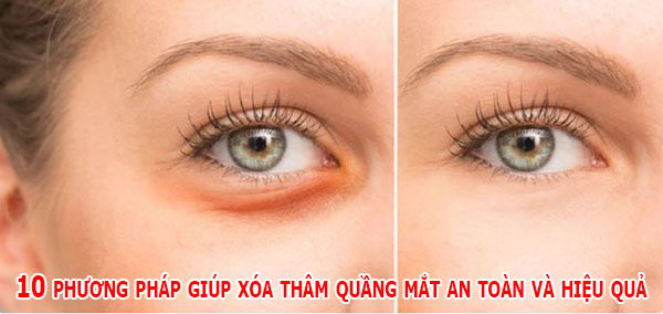 10 phương pháp giúp xóa thâm quầng mắt an toàn và hiệu quả